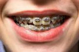 Brackets